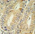 15-PGDH / HPGD Antibody - HPGD Antibody IHC of formalin-fixed and paraffin-embedded human colon carcinoma followed by peroxidase-conjugated secondary antibody and DAB staining.
