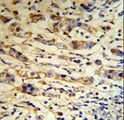 A1BG Antibody - A1BG Antibody (RB18670) IHC of formalin-fixed and paraffin-embedded human breast carcinoma tissue followed by peroxidase-conjugated secondary antibody and DAB staining.