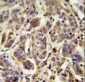 AAGAB Antibody - FLJ11506 Antibody immunohistochemistry of formalin-fixed and paraffin-embedded human cervix carcinoma followed by peroxidase-conjugated secondary antibody and DAB staining.