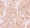 AAMP Antibody - AAMP antibody IHC-paraffin: Human Mammary Cancer Tissue.