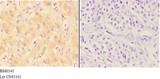 AANAT Antibody - Immunohistochemistry (IHC) analysis of AANAT antibody in paraffin-embedded human liver carcinoma tissue at 1:50, showing cytoplasmic strong positive staining. Negative control (the right) using PBS instead of primary antibody. Secondary antibody is Goat Anti-Rabbit IgG.