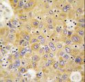 AARS Antibody - Formalin-fixed and paraffin-embedded human hepatocarcinoma tissue reacted with AARS antibody , which was peroxidase-conjugated to the secondary antibody, followed by DAB staining. This data demonstrates the use of this antibody for immunohistochemistry; clinical relevance has not been evaluated.