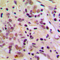 AATF Antibody - Immunohistochemical analysis of AATF staining in human breast cancer formalin fixed paraffin embedded tissue section. The section was pre-treated using heat mediated antigen retrieval with sodium citrate buffer (pH 6.0). The section was then incubated with the antibody at room temperature and detected using an HRP conjugated compact polymer system. DAB was used as the chromogen. The section was then counterstained with hematoxylin and mounted with DPX.