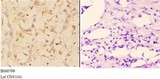 ABCA4 Antibody - Immunohistochemistry (IHC) analysis of ABCA4 antibody in paraffin-embedded human kidney carcinoma tissue at 1:50, showing membrane staining. Negative control (the right) using PBS instead of primary antibody. Secondary antibody is Goat Anti-Rabbit IgG-biotin.