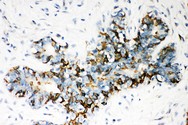 ABCB4 / MDR3 Antibody - ABCB4 antibody IHC-paraffin: Human Mammary Cancer Tissue.