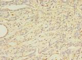 ABCB5 Antibody - Immunohistochemistry of paraffin-embedded human breast cancer using antibody at dilution of 1:100.