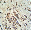 ABCC11 / MRP8 Antibody - ABCC11 Antibody IHC of formalin-fixed and paraffin-embedded breast carcinoma followed by peroxidase-conjugated secondary antibody and DAB staining.