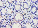 ABCE1 Antibody - Immunohistochemistry of paraffin-embedded human colon cancer using antibody at 1:100 dilution.
