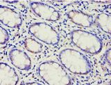 ABCF2 Antibody - Immunohistochemistry of paraffin-embedded human colon cancer using antibody at 1:100 dilution.