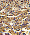 ABCG1 Antibody - Formalin-fixed and paraffin-embedded human hepatocarcinoma reacted with ABCG1 Antibody , which was peroxidase-conjugated to the secondary antibody, followed by DAB staining. This data demonstrates the use of this antibody for immunohistochemistry; clinical relevance has not been evaluated.