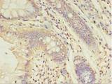 ABHD14A Antibody - Immunohistochemistry of paraffin-embedded human colon cancer using antibody at 1:100 dilution.