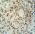 ABHD14B Antibody - ABHEB Antibody immunohistochemistry of formalin-fixed and paraffin-embedded human lung carcinoma followed by peroxidase-conjugated secondary antibody and DAB staining.