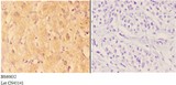 ABHD3 Antibody - Immunohistochemistry (IHC) analysis of ABHD3 antibody in paraffin-embedded human liver carcinoma tissue at 1:50, showing cytoplasmic and membrane staining. Negative control (the right) using PBS instead of primary antibody. Secondary antibody is Goat Anti-Rabbit.