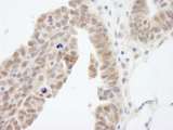 ABI1 / SSH3BP1 Antibody - Detection of Human ABI1 by Immunohistochemistry. Sample: FFPE section of human prostate carcinoma. Antibody: Affinity purified rabbit anti-ABI1 used at a dilution of 1:200 (1 ug/ml).