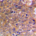ABL Antibody - Immunohistochemical analysis of ABL1/2 (pY393/439) staining in human breast cancer formalin fixed paraffin embedded tissue section. The section was pre-treated using heat mediated antigen retrieval with sodium citrate buffer (pH 6.0). The section was then incubated with the antibody at room temperature and detected using an HRP conjugated compact polymer system. DAB was used as the chromogen. The section was then counterstained with hematoxylin and mounted with DPX.