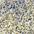 ABO Glycosyltransferase Antibody - Immunohistochemical analysis of ABO staining in human esophageal cancer formalin fixed paraffin embedded tissue section. The section was pre-treated using heat mediated antigen retrieval with sodium citrate buffer (pH 6.0). The section was then incubated with the antibody at room temperature and detected using an HRP conjugated compact polymer system. DAB was used as the chromogen. The section was then counterstained with hematoxylin and mounted with DPX.
