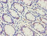 ACAD9 Antibody - Immunohistochemistry of paraffin-embedded human colon cancer tissue using antibody at 1:100 dilution.