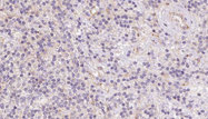 ACADVL Antibody - 1:100 staining human lymph carcinoma tissue by IHC-P. The sample was formaldehyde fixed and a heat mediated antigen retrieval step in citrate buffer was performed. The sample was then blocked and incubated with the antibody for 1.5 hours at 22°C. An HRP conjugated goat anti-rabbit antibody was used as the secondary.