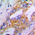 ACAN / Aggrecan Antibody - Immunohistochemical analysis of Aggrecan staining in human lung cancer formalin fixed paraffin embedded tissue section. The section was pre-treated using heat mediated antigen retrieval with sodium citrate buffer (pH 6.0). The section was then incubated with the antibody at room temperature and detected using an HRP conjugated compact polymer system. DAB was used as the chromogen. The section was then counterstained with hematoxylin and mounted with DPX.