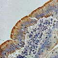 ACCS / ACS Antibody - Immunohistochemical analysis of PHACS staining in human colon cancer formalin fixed paraffin embedded tissue section. The section was pre-treated using heat mediated antigen retrieval with sodium citrate buffer (pH 6.0). The section was then incubated with the antibody at room temperature and detected using an HRP conjugated compact polymer system. DAB was used as the chromogen. The section was then counterstained with hematoxylin and mounted with DPX.