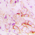 ACE / CD143 Antibody - Immunohistochemical analysis of CD143 staining in human breast cancer formalin fixed paraffin embedded tissue section. The section was pre-treated using heat mediated antigen retrieval with sodium citrate buffer (pH 6.0). The section was then incubated with the antibody at room temperature and detected using an HRP conjugated compact polymer system. DAB was used as the chromogen. The section was then counterstained with hematoxylin and mounted with DPX.