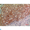 ACER2 Antibody - Immunohistochemistry (IHC) analysis of paraffin-embedded Human Breast Cancer, antibody was diluted at 1:200.