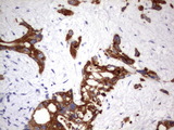 Acidic Cytokeratin Antibody - IHC of paraffin-embedded Carcinoma of Human pancreas tissue using anti-Acidic CK rat monoclonal antibody.