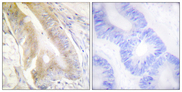 ACO1 / Aconitase Antibody - Immunohistochemistry analysis of paraffin-embedded human colon carcinoma tissue, using IREB1 Antibody. The picture on the right is blocked with the synthesized peptide.