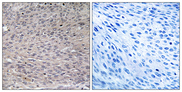 ACO1 / Aconitase Antibody - Immunohistochemistry analysis of paraffin-embedded human thyroid gland, using IREB1 (Phospho-Ser711) Antibody. The picture on the right is blocked with the phospho peptide.