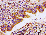 ACO2 / Aconitase 2 Antibody - Immunohistochemistry image of paraffin-embedded human lung cancer at a dilution of 1:100