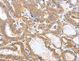 ACOT11 / THEA Antibody - Immunohistochemistry of paraffin-embedded Human thyroid cancer using ACOT11 Polyclonal Antibody at dilution of 1:25.