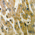 ACOT4 Antibody - Immunohistochemical analysis of ACOT4 staining in human liver cancer formalin fixed paraffin embedded tissue section. The section was pre-treated using heat mediated antigen retrieval with sodium citrate buffer (pH 6.0). The section was then incubated with the antibody at room temperature and detected using an HRP conjugated compact polymer system. DAB was used as the chromogen. The section was then counterstained with hematoxylin and mounted with DPX.