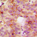 ACOT8 Antibody - Immunohistochemical analysis of ACOT8 staining in human breast cancer formalin fixed paraffin embedded tissue section. The section was pre-treated using heat mediated antigen retrieval with sodium citrate buffer (pH 6.0). The section was then incubated with the antibody at room temperature and detected using an HRP conjugated compact polymer system. DAB was used as the chromogen. The section was then counterstained with hematoxylin and mounted with DPX.