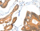 ACOX3 Antibody - Immunohistochemistry of paraffin-embedded Human colon cancer using ACOX3 Polyclonal Antibody at dilution of 1:35.