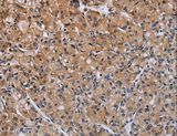 ACP6 Antibody - Immunohistochemistry of paraffin-embedded Human prostate cancer using ACP6 Polyclonal Antibody at dilution of 1:50.
