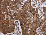 ACP6 Antibody - Immunohistochemistry of paraffin-embedded Human liver cancer using ACP6 Polyclonal Antibody at dilution of 1:30.