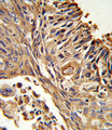 AcPL / IL18RAP Antibody - Formalin-fixed and paraffin-embedded human lung carcinoma reacted with IL18RAP Antibody , which was peroxidase-conjugated to the secondary antibody, followed by DAB staining. This data demonstrates the use of this antibody for immunohistochemistry; clinical relevance has not been evaluated.