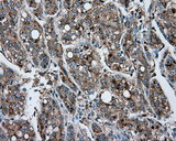 ACSBG1 / hsBG Antibody - Immunohistochemical staining of paraffin-embedded Carcinoma of Human liver tissue using anti-ACSBG1 mouse monoclonal antibody.
