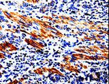 ACSBG2 Antibody - Immunohistochemistry of paraffin-embedded Human stomach cancer using ACSBG2 Polyclonal Antibody at dilution of 1:60.