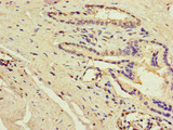 ACSF3 Antibody - Immunohistochemistry of paraffin-embedded human prostate cancer at dilution of 1:100