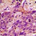 ACSS1 Antibody - Immunohistochemical analysis of ACSS1 staining in human prostate cancer formalin fixed paraffin embedded tissue section. The section was pre-treated using heat mediated antigen retrieval with sodium citrate buffer (pH 6.0). The section was then incubated with the antibody at room temperature and detected with HRP and DAB as chromogen. The section was then counterstained with hematoxylin and mounted with DPX.
