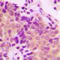 Antibody - Immunohistochemical analysis of ACTN1/2/3/4 staining in human breast cancer formalin fixed paraffin embedded tissue section. The section was pre-treated using heat mediated antigen retrieval with sodium citrate buffer (pH 6.0). The section was then incubated with the antibody at room temperature and detected using an HRP conjugated compact polymer system. DAB was used as the chromogen. The section was then counterstained with hematoxylin and mounted with DPX.