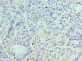 ACTR1A / Centractin Antibody - Immunohistochemistry of paraffin-embedded human lung cancer using antibody at 1:100 dilution.