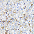 ACTR2 / ARP2 Antibody - Immunohistochemistry of paraffin-embedded human lung cancer tissue.