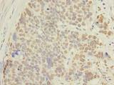 ACTRT1 Antibody - Immunohistochemistry of paraffin-embedded human gastric cancer using antibody at dilution of 1:100.