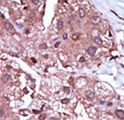 ACVRL1 Antibody - Formalin-fixed and paraffin-embedded human cancer tissue reacted with the primary antibody, which was peroxidase-conjugated to the secondary antibody, followed by DAB staining. This data demonstrates the use of this antibody for immunohistochemistry; clinical relevance has not been evaluated. BC = breast carcinoma; HC = hepatocarcinoma.