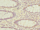 ADAD1 Antibody - Immunohistochemistry of paraffin-embedded human colon cancer at dilution 1:100