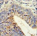 ADAMDEC1 Antibody - Formalin-fixed and paraffin-embedded human colon carcinoma reacted with ADAMDEC1 Antibody , which was peroxidase-conjugated to the secondary antibody, followed by DAB staining. This data demonstrates the use of this antibody for immunohistochemistry; clinical relevance has not been evaluated.