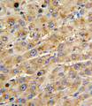 ADAMTS13 Antibody - Formalin-fixed and paraffin-embedded human hepatocarcinoma with ADAMTS13 Antibody , which was peroxidase-conjugated to the secondary antibody, followed by DAB staining. This data demonstrates the use of this antibody for immunohistochemistry; clinical relevance has not been evaluated.