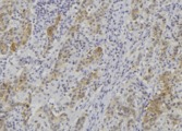 ADAMTS14 Antibody - 1:100 staining human lung carcinoma tissue by IHC-P. The sample was formaldehyde fixed and a heat mediated antigen retrieval step in citrate buffer was performed. The sample was then blocked and incubated with the antibody for 1.5 hours at 22°C. An HRP conjugated goat anti-rabbit antibody was used as the secondary.